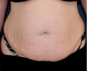 Tummy Tuck 217 - before - front