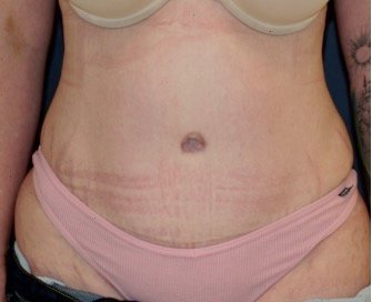 Tummy Tuck 217 - after - front
