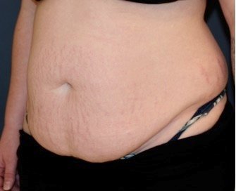 Tummy Tuck 217 - before - oblique