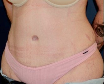 Tummy Tuck 217 - after - oblique