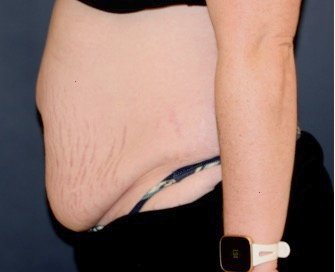 Tummy Tuck 217 - before - side