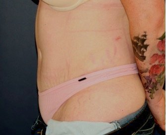 Tummy Tuck 217 - after - side