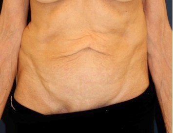 Tummy Tuck 218 - before - front