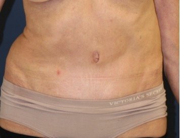 Tummy Tuck 218 - after - front