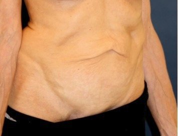 Tummy Tuck 218 - before - oblique