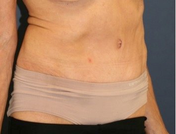 Tummy Tuck 218 - after - oblique