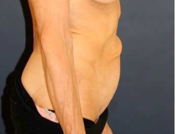 Tummy Tuck 218 - before - side
