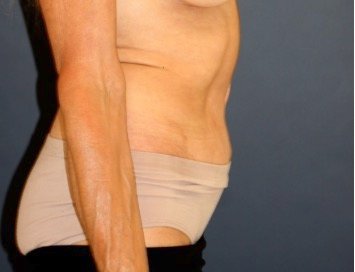 Tummy Tuck 218 - after - side