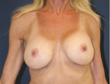 Breast Augmentation 138 - after - front