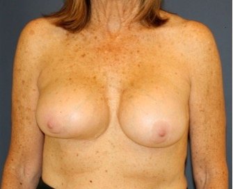Breast Revision with Augmentation 405 - before - front