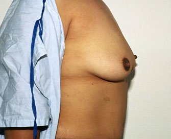 Breast Augmentation Case 37 - before - side