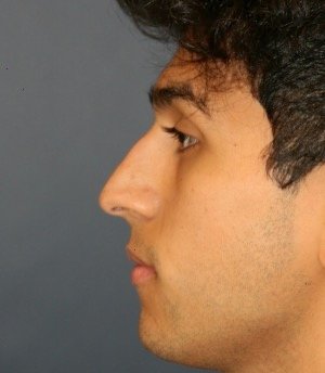 Rhinoplasty 204 - before - front