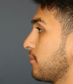 Rhinoplasty 204 - after - front