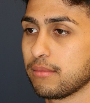 Rhinoplasty 204 - after - oblique