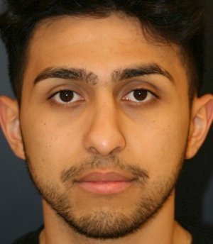 Rhinoplasty 204 - after - side
