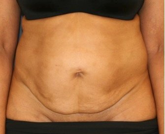Tummy Tuck 219 - before - front