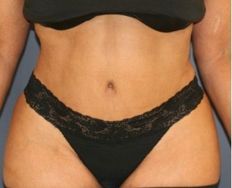 Tummy Tuck 219 - after - front
