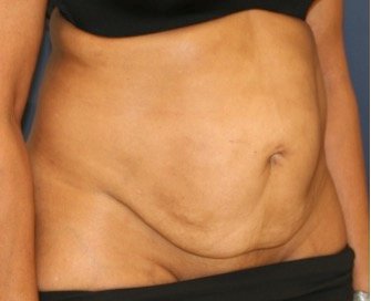 Tummy Tuck 219 - before - oblique