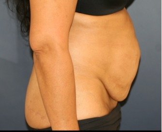 Tummy Tuck 219 - before - side