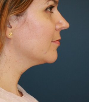Necklift 204 - before - front