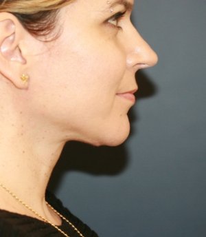 Necklift 204 - after - front