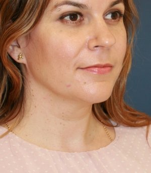 Necklift 204 - before - oblique
