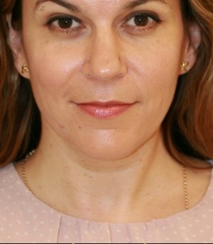 Necklift 204 - before - side