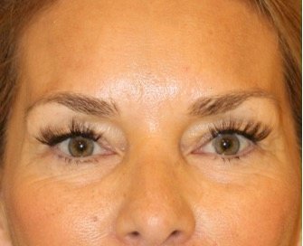 Blepharoplasty 105 - before - front
