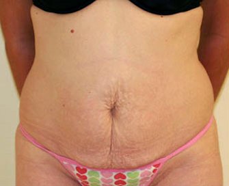 Tummy Tuck Case 7 - before - front