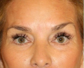 Blepharoplasty 105 - after - front