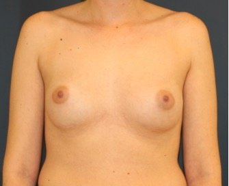 Breast Revision 406 - before - front