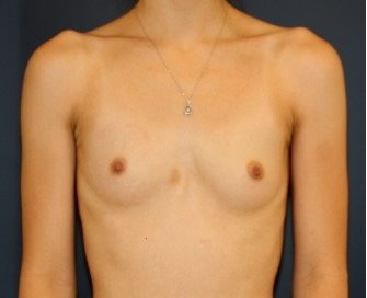 Breast Augmentation 139 - before - front