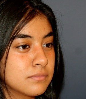 Rhinoplasty 205 - after - oblique