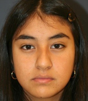 Rhinoplasty 205 - before - side