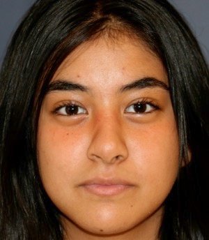 Rhinoplasty 205 - after - side