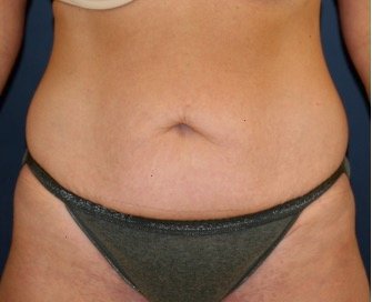 Tummy Tuck 220 - before - front