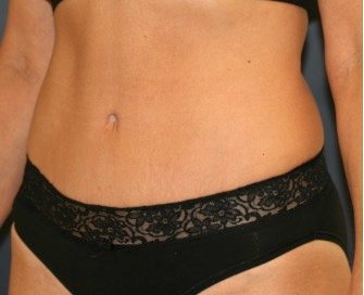Tummy Tuck 220 - after - oblique