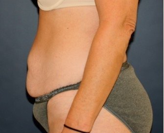 Tummy Tuck 220 - before - side