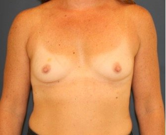 Breast Augmentation 140 - before - front