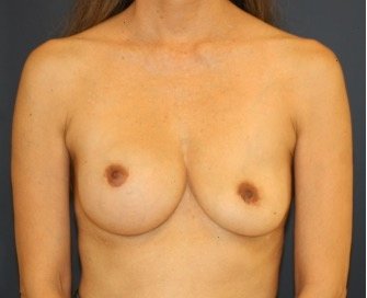 Breast Revision with Augmentation 407 - before - oblique
