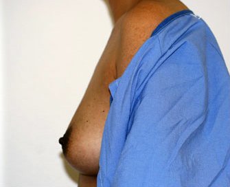 Breast Augmentation Case 39 - before - side