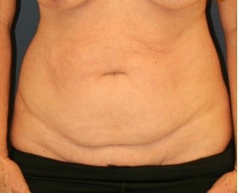 Tummy Tuck 221 - before - front