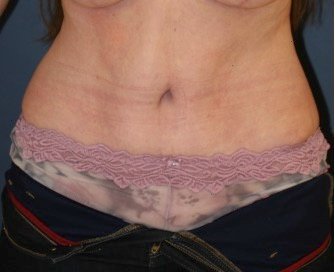 Tummy Tuck 221 - after - front