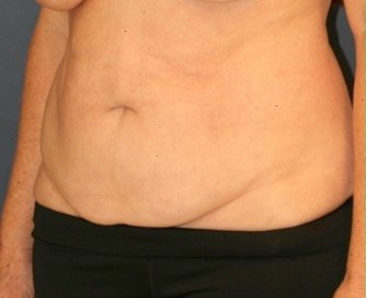 Tummy Tuck 221 - before - oblique