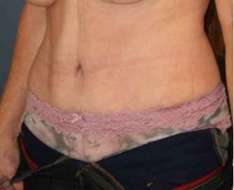 Tummy Tuck 221 - after - oblique