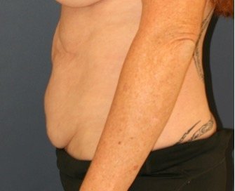 Tummy Tuck 221 - before - side