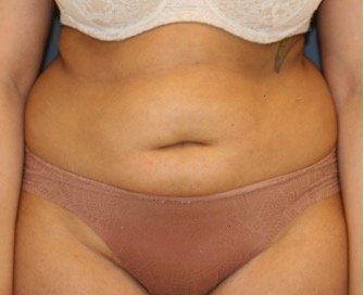 Tummy Tuck 222 - before - front
