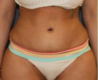 Tummy Tuck 222 - after - front