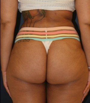 Liposuction Back-Waist-Front 206 - after - front