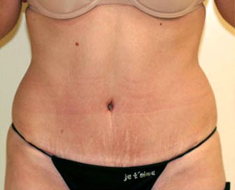 Tummy Tuck Case 7 - after - front